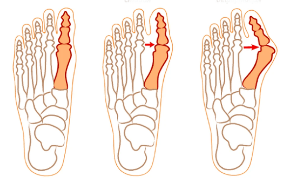 Деформация на Hallux valgus