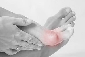 Hallux valgus как да изберем обувки