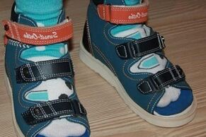 носене на сандали при халукс валгус при дете