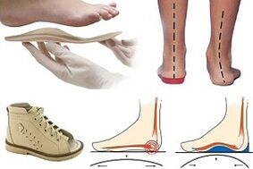 ортопедични обувки за халукс валгус при дете